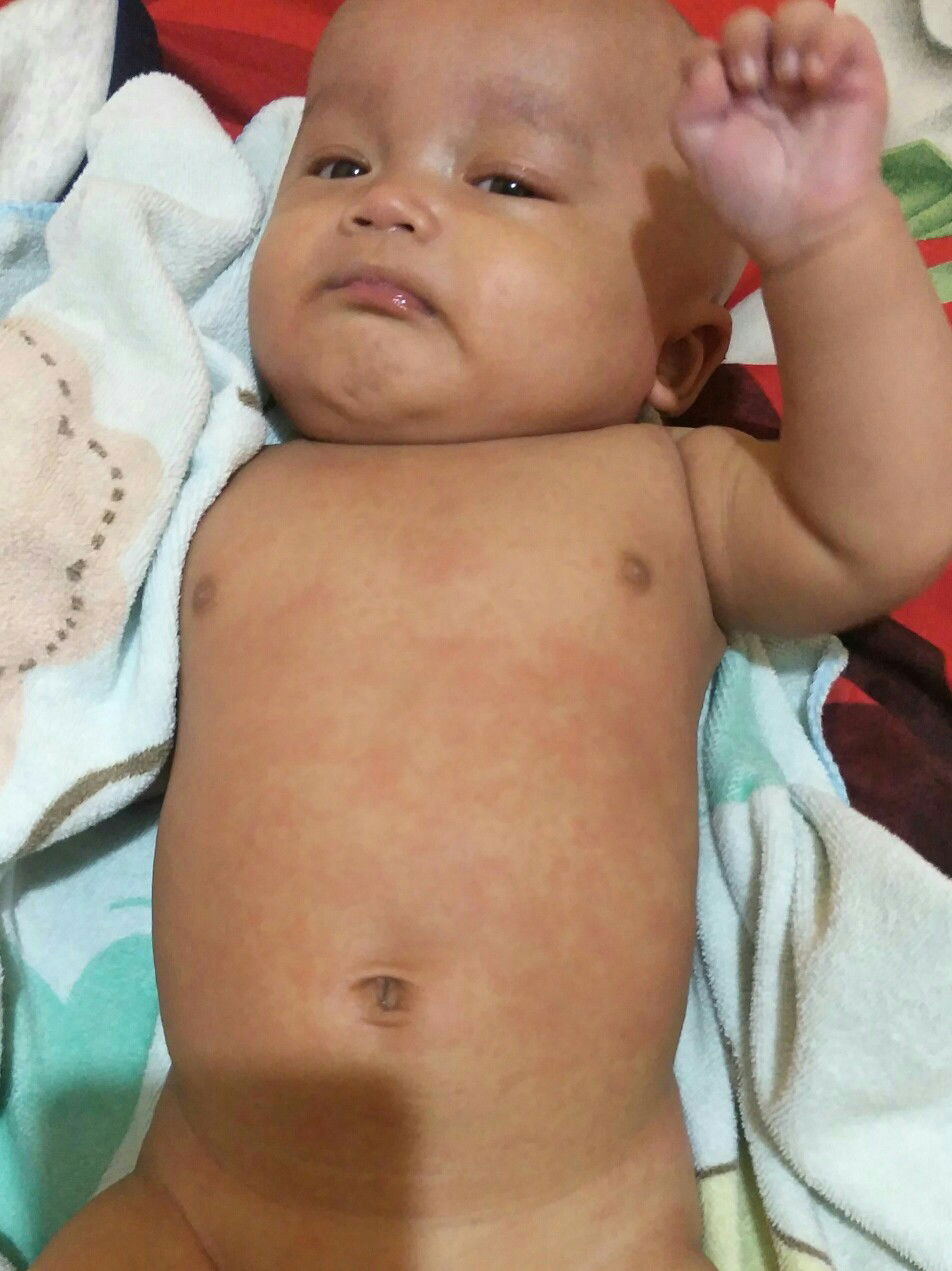 merah merah seluruh badan