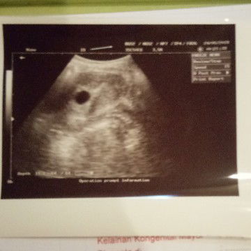 menghitung usia kandungan dan usg