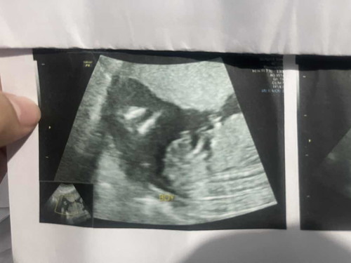 baby gender at 19 weeks