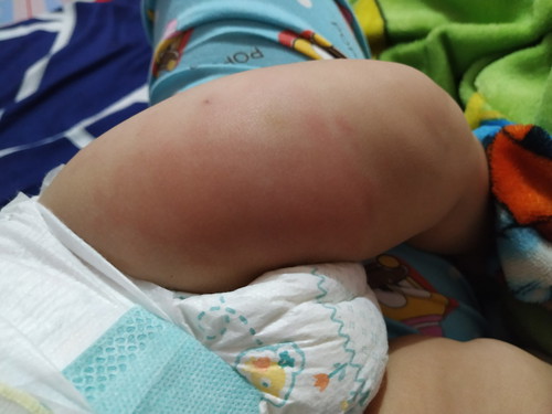 Redness and swelling after penta vaccine