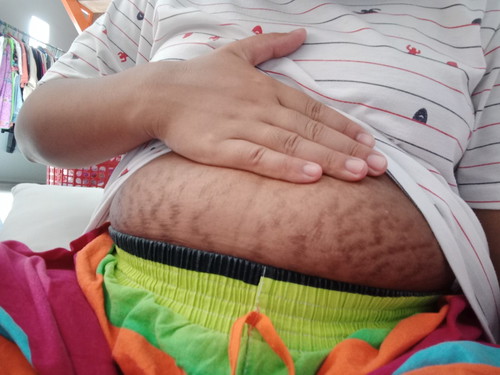 รอยแตกลายหลังคลอด