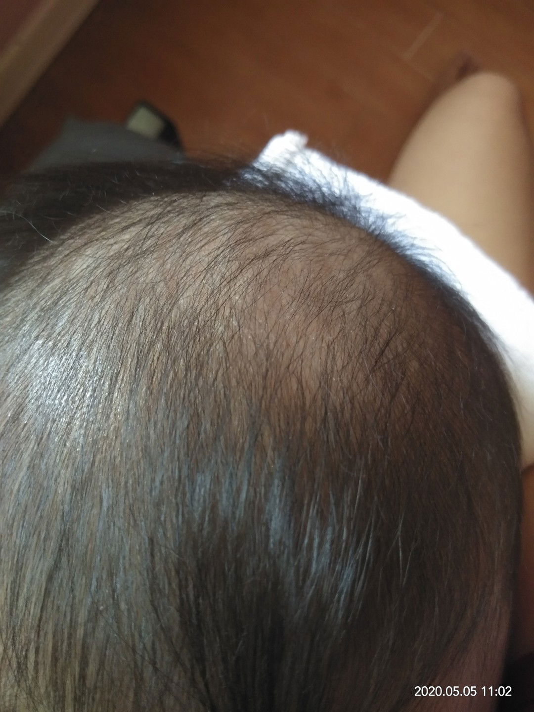 Baby Dandruff?