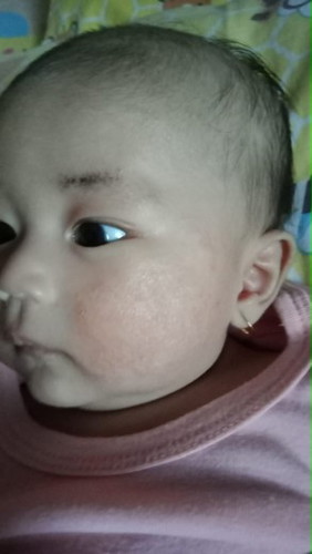 gatal