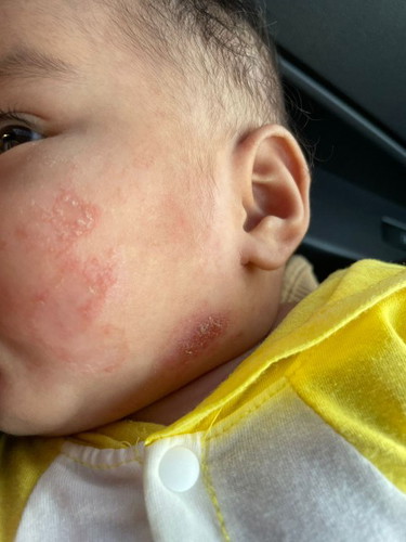 Anak eczema