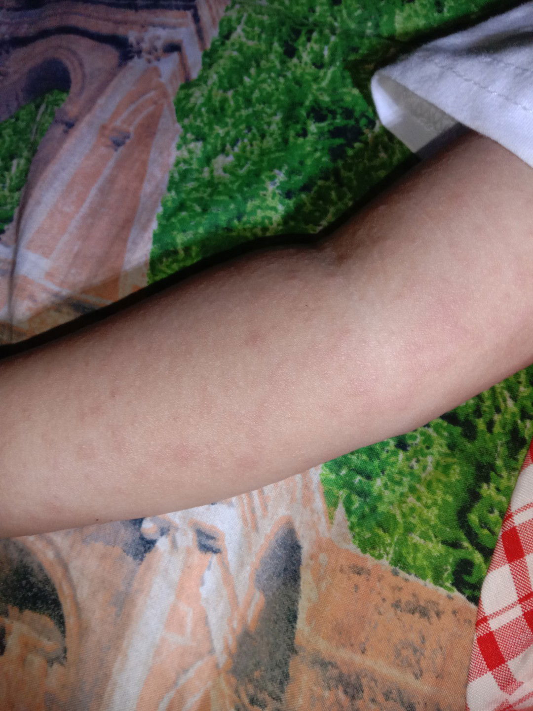 Ruam kulit bayi 1 tahun 
Ada gk bun yg anknya gini, entah karena alergi mkanan atau apa