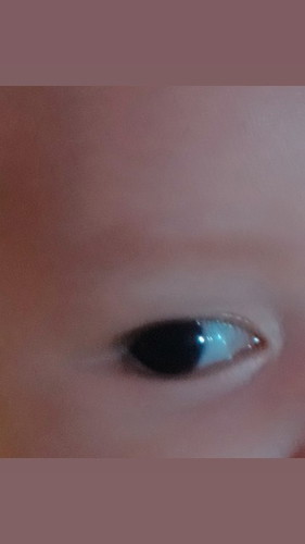 mata di pinggir ada bercak