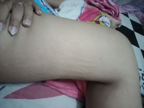 ผื่นคัน