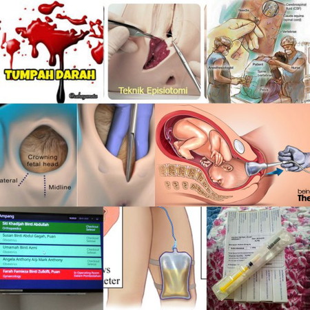 Proses melahirkan Adra Aliesya..??