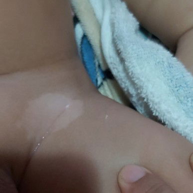 kulit belang pada lipatan paha bayi