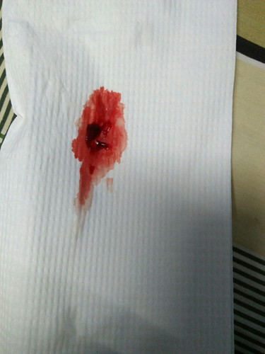มีเลือดออก