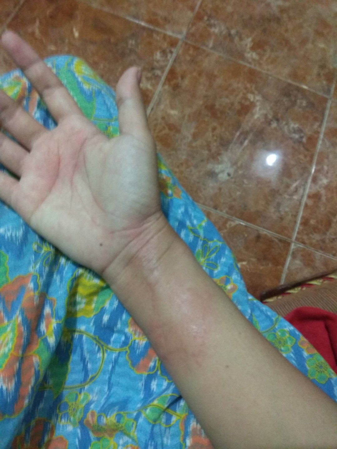 Biduran