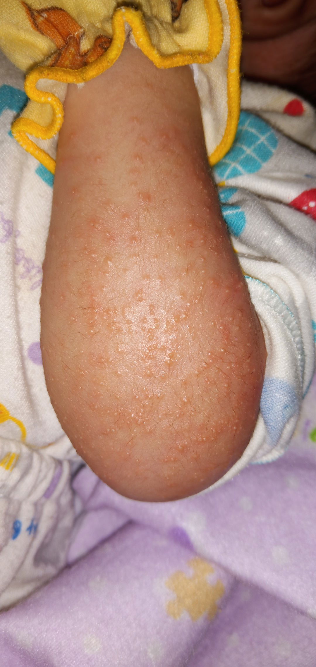 bruntusan tangan kiri kanan bayi newborn