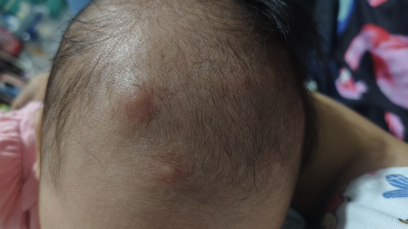 Pantal po ba ito or allergy?