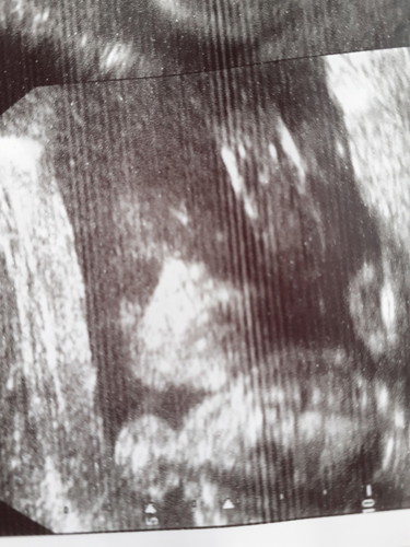 หลังจากมีเลือดออกทางช่องคลอด