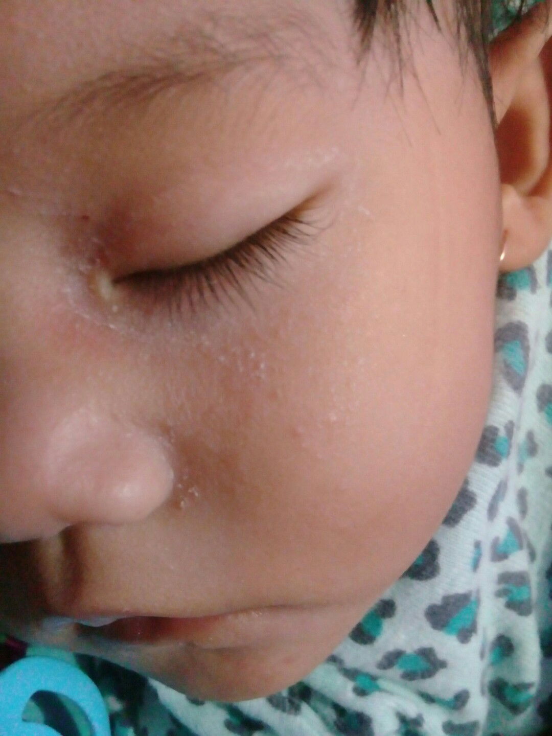 beruntus pada wajah bayi