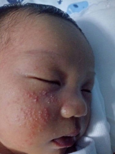 Newborn Face Rashes