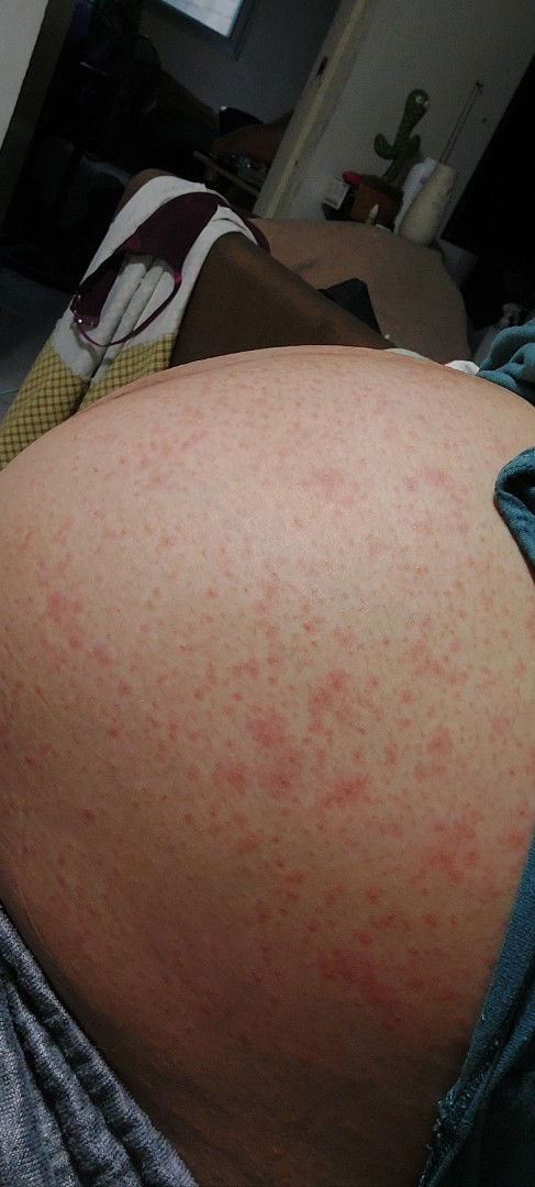 PUPPS (Pruritic Urticarial Papules and Plaques of Pregnancy)