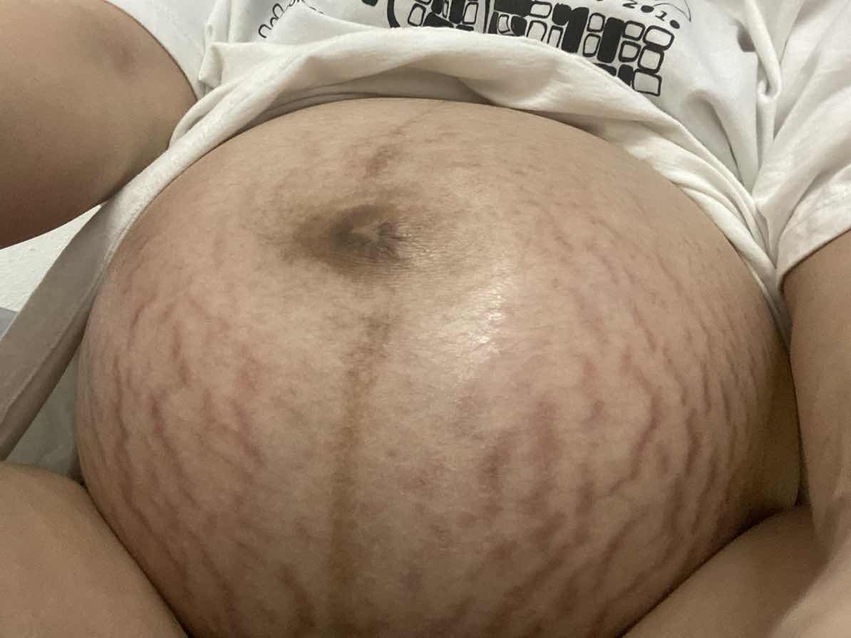 ท้องแตกลายกนักมาก