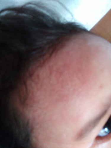 Skin Allergy
