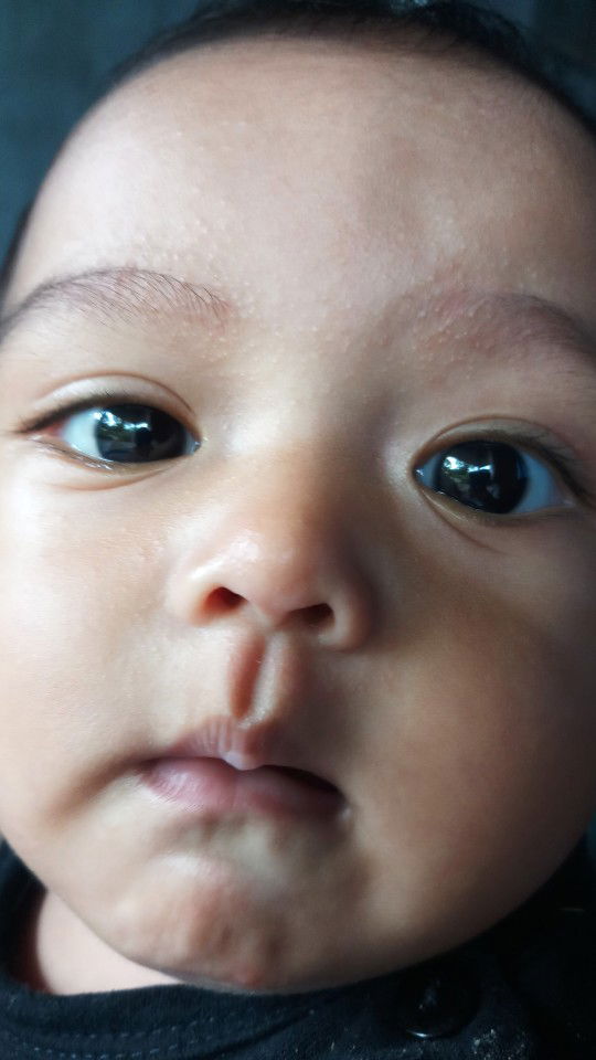 bintik bintik di muka