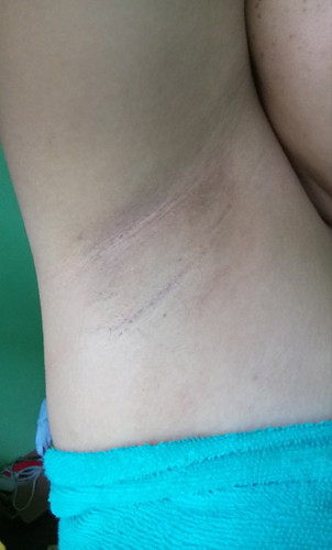 Kilikili Problem?