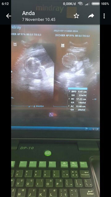 Bun mau tanya maksud dari hasil usg ini apa ya