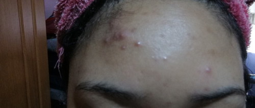 acne problem