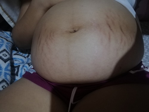 stretch marks