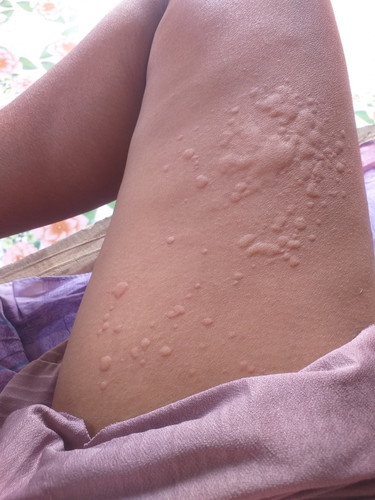 เป็นแบบนี้มีผลต่อลูกในท้องไหมค่ะ
