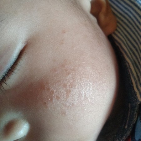 Kulit kering
