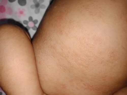 kulit bayi merah