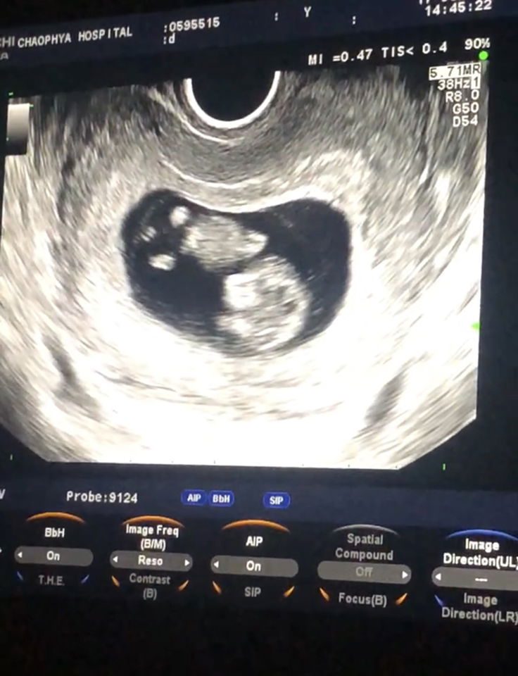 สอบถามแม่ๆค่ะ เราตั้งครรภ์ได้ 11w แล้วค่ะ มีเลือดปนตกขาว