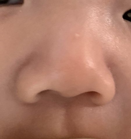 White bump on LO nose