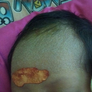 baby bruntusan