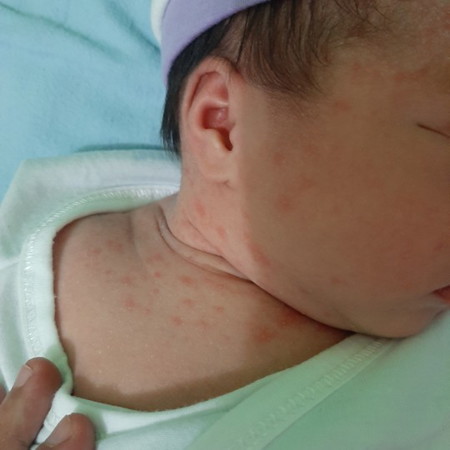 Rashes?