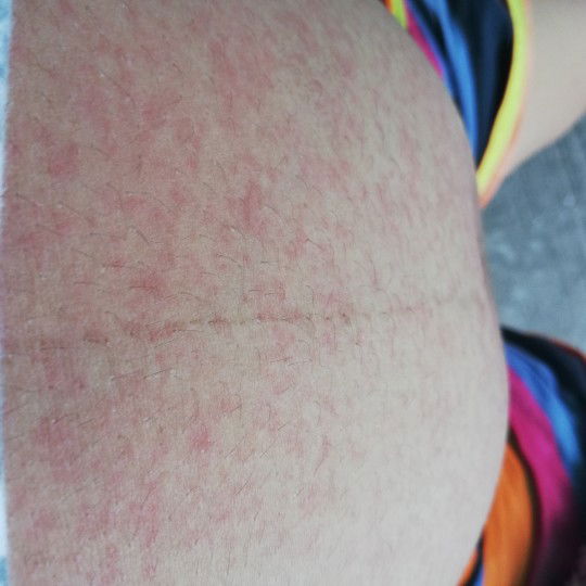 แบบนี้คือไรคะมีไข้ และปวดตามเนื้อตามตัวมากๆค่ะ