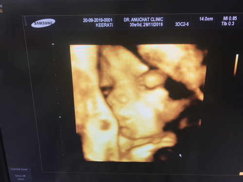 น้องจัสมิน 30 วีค 4D