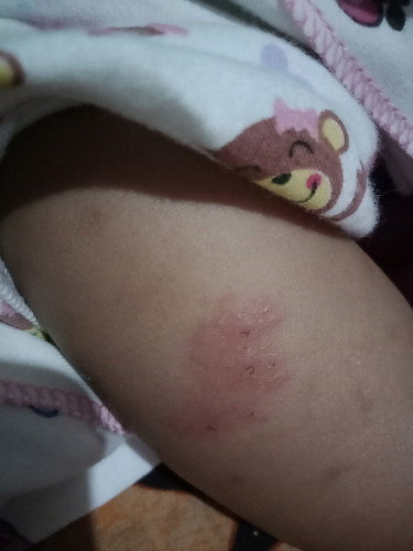 gatal gatal