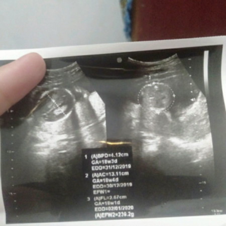 hamil anak pertama