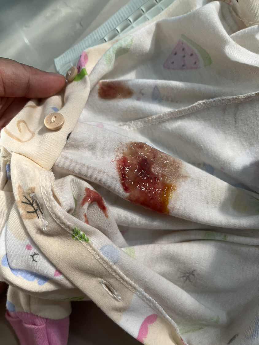 BAB bayi 2 bulan campur darah n lendir