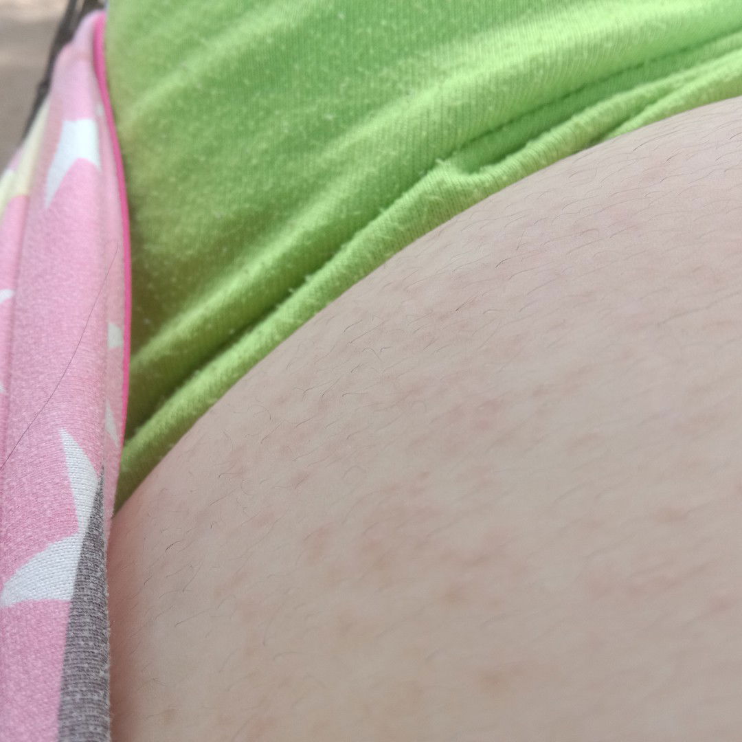 Normal Po ba magka rashes