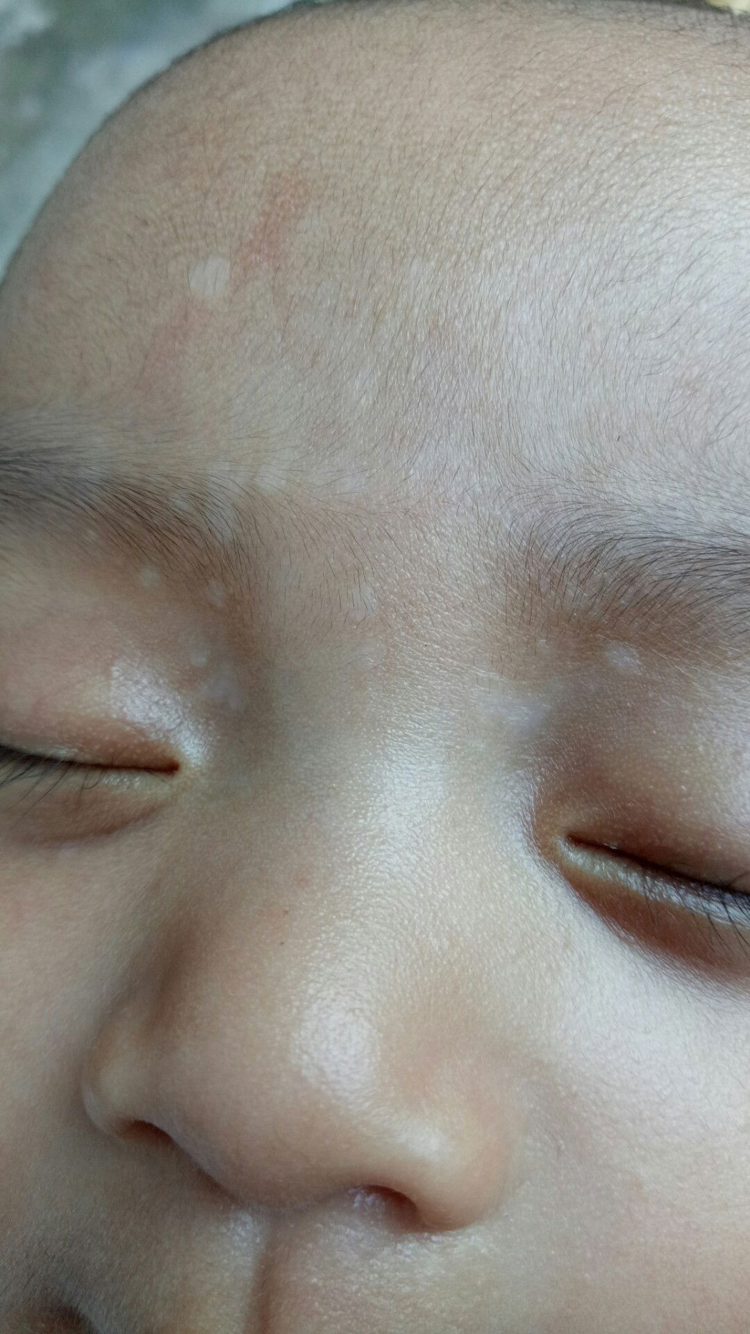 bintik2 putih d kening