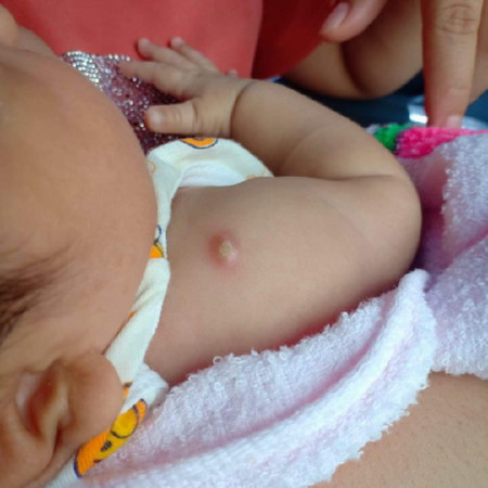 ปลูกฝีที่แขน