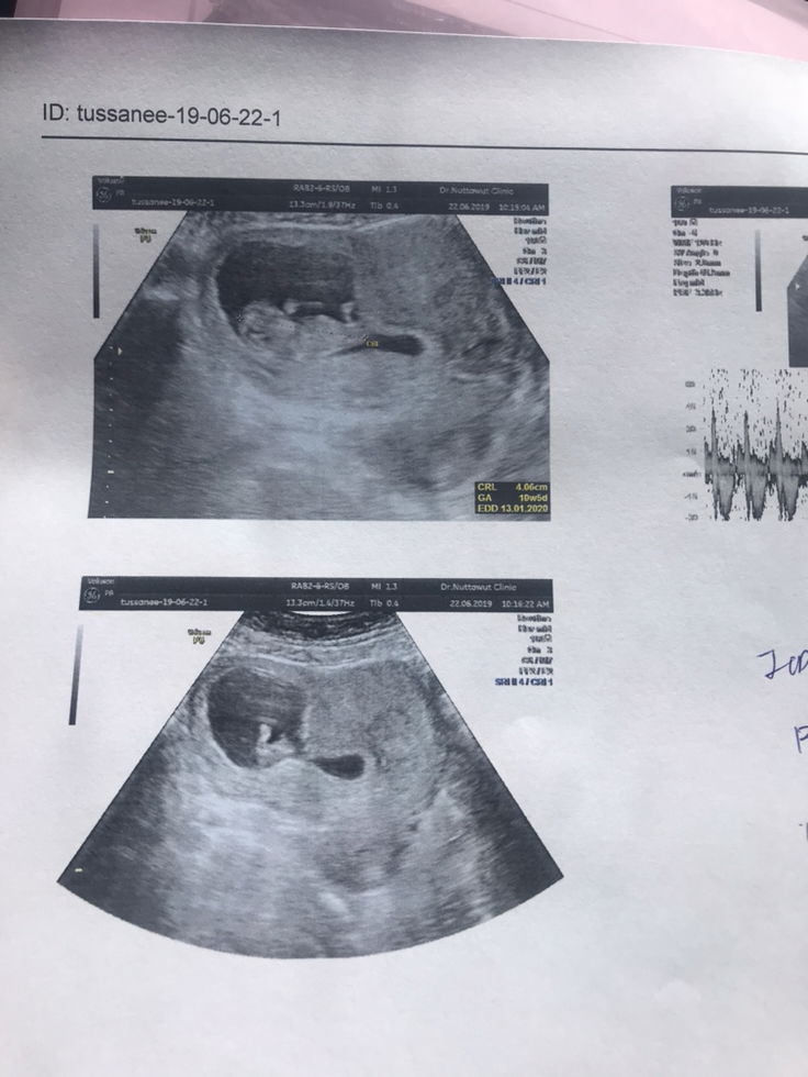 มดลูกรูปหัวใจ