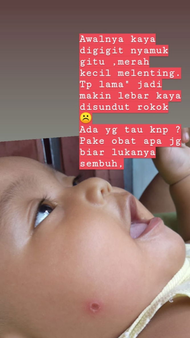 Luka di muka bayi