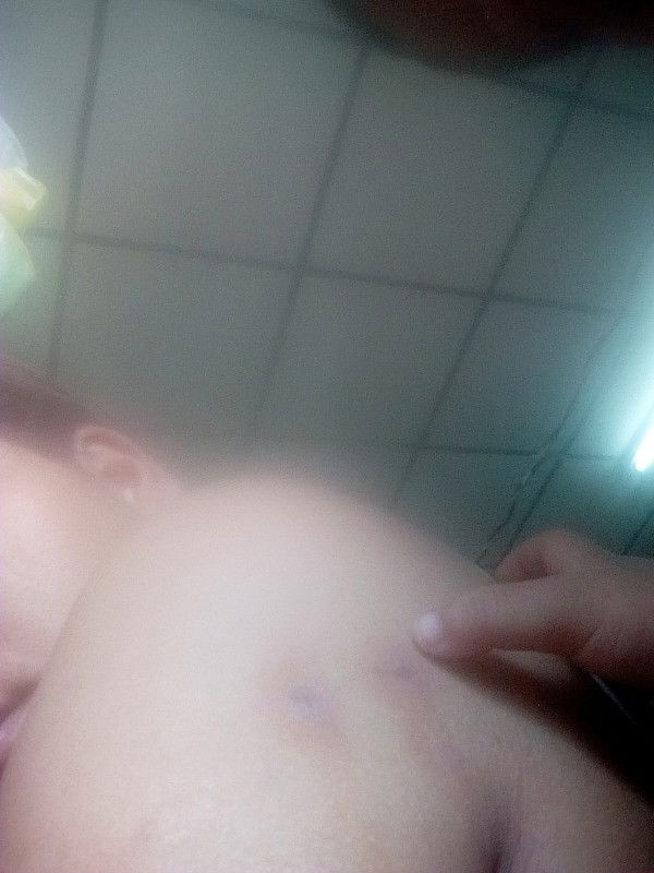 แม่ตั้งครรภ์เคยโดนแมลงก้นกะดกต่อยไหมค่ะ