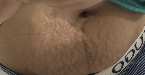 Stretch mark