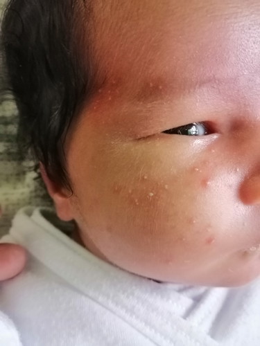 Rashes Sa Mukha