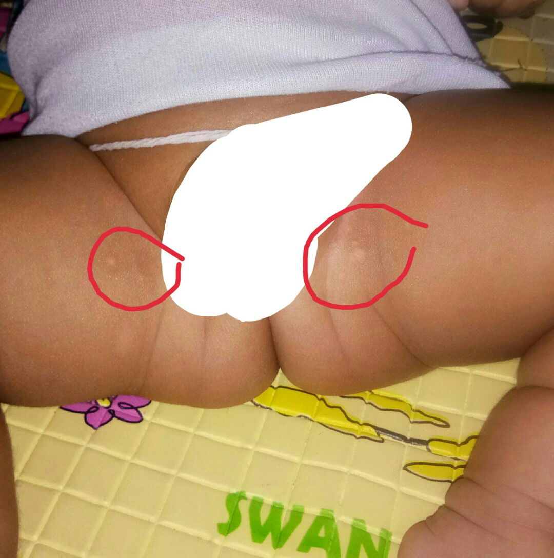 bentol putih didalam lingkaran merah