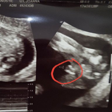 baby's gender at 12 weeks